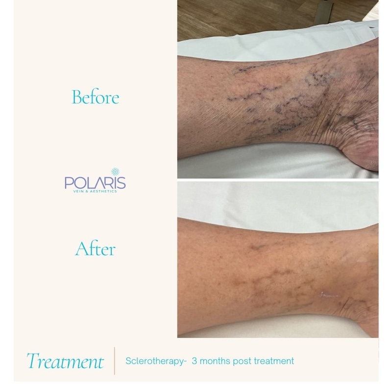Polaris Vein & Aesthetics Highlights Importance of Early Detection During Varicose Vein Awareness Month