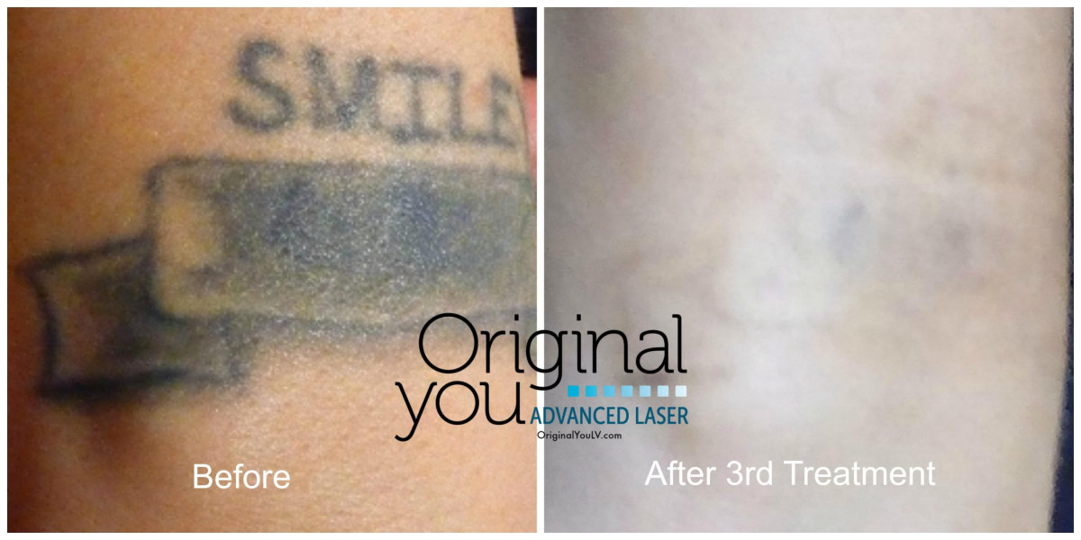 Introducing a 10-Treatment Guarantee for Laser Tattoo Removal
